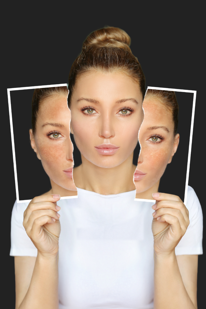 DEFINING MELASMA